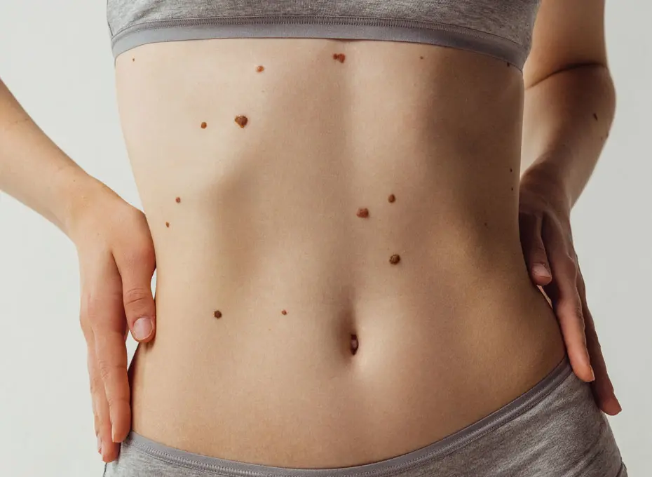 Ahid Abood Plastic Surgery - Moles and lesions