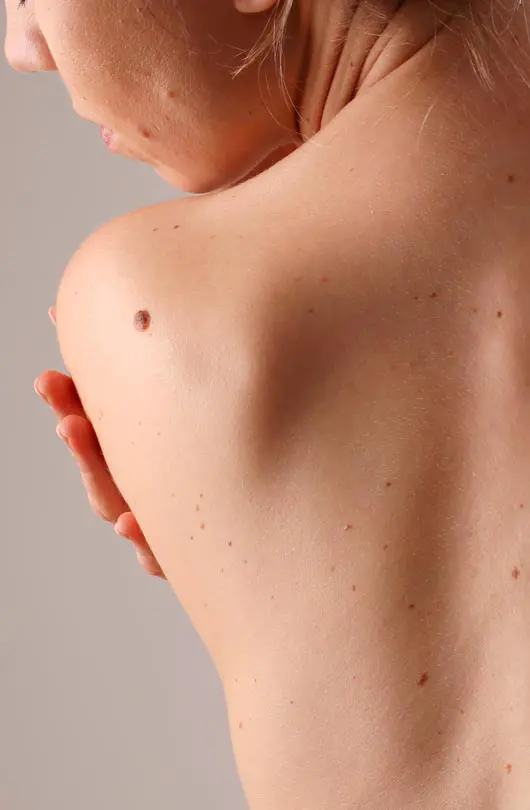 AA Plastic Surgery - Electrosurgery & Curettage