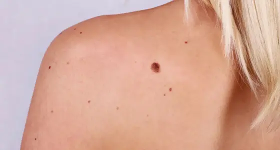 Ahid-Abood - Plastic Surgery Reconstruction After Skin Cancer Removal