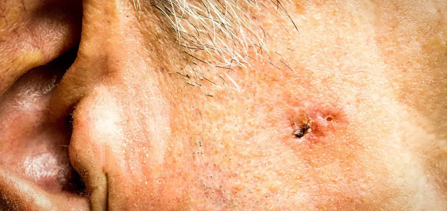 Ahid Abood - Basal Cell Carcinoma