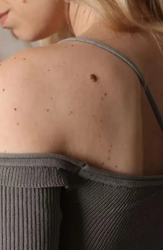 Ahid Abood - Skin Tags