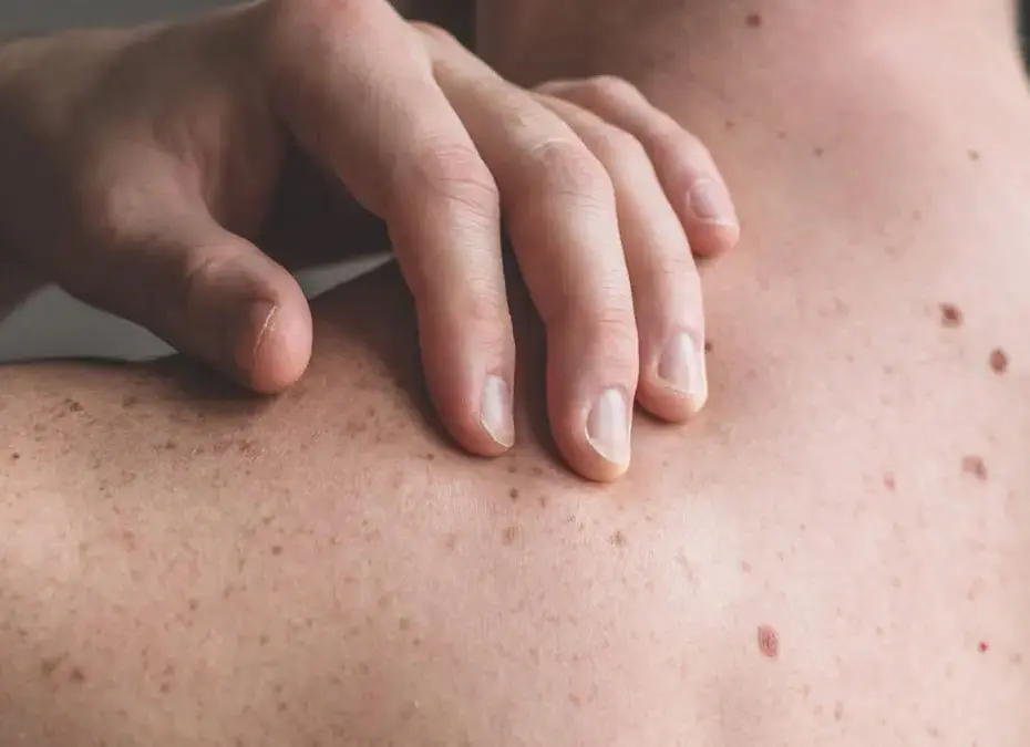 Ahid Abood - Skin Excision