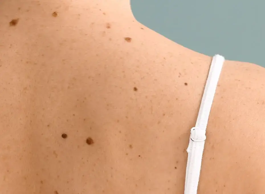 Ahid Abood - Surgical Excision For Skin Cancer