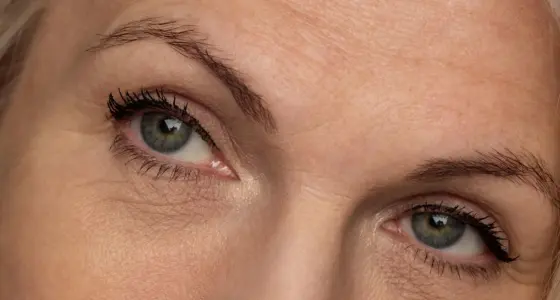 AA Plastic Surgery - Brow Lift