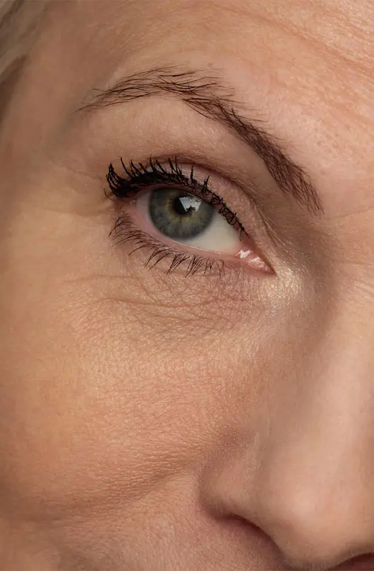 AA Plastic Surgery - Brow Lift