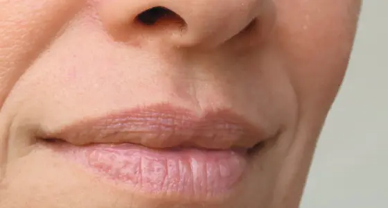 AA Plastic Surgery - Deep Nasolabial Folds & Marionette Lines