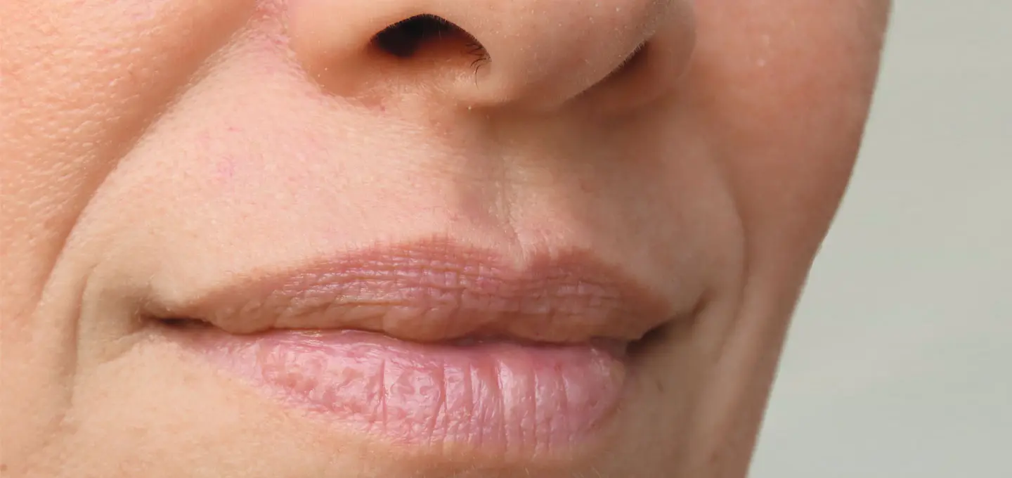 AA Plastic Surgery - Deep Nasolabial Folds & Marionette Lines