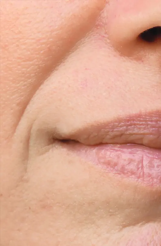 AA Plastic Surgery - Deep Nasolabial Folds & Marionette Lines