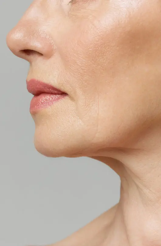 AA Plastic Surgery - Drooping Mid-Face & Cheek Descent