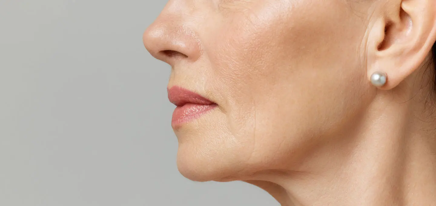 AA Plastic Surgery - Drooping Mid-Face & Cheek Descent