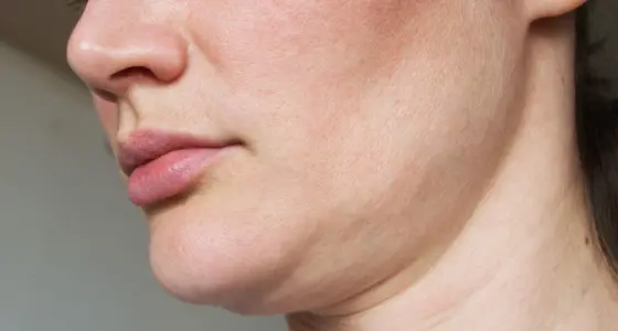 AA Plastic Surgery - Sagging Skin - Skin Laxity (Face & Neck)