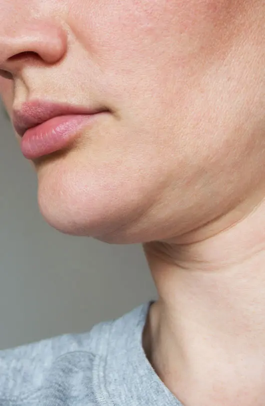 AA Plastic Surgery - Sagging Skin - Skin Laxity (Face & Neck)