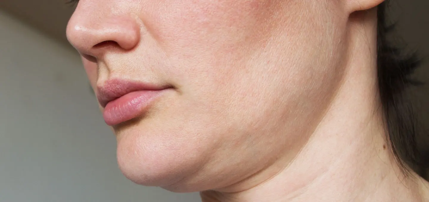 AA Plastic Surgery - Sagging Skin - Skin Laxity (Face & Neck)
